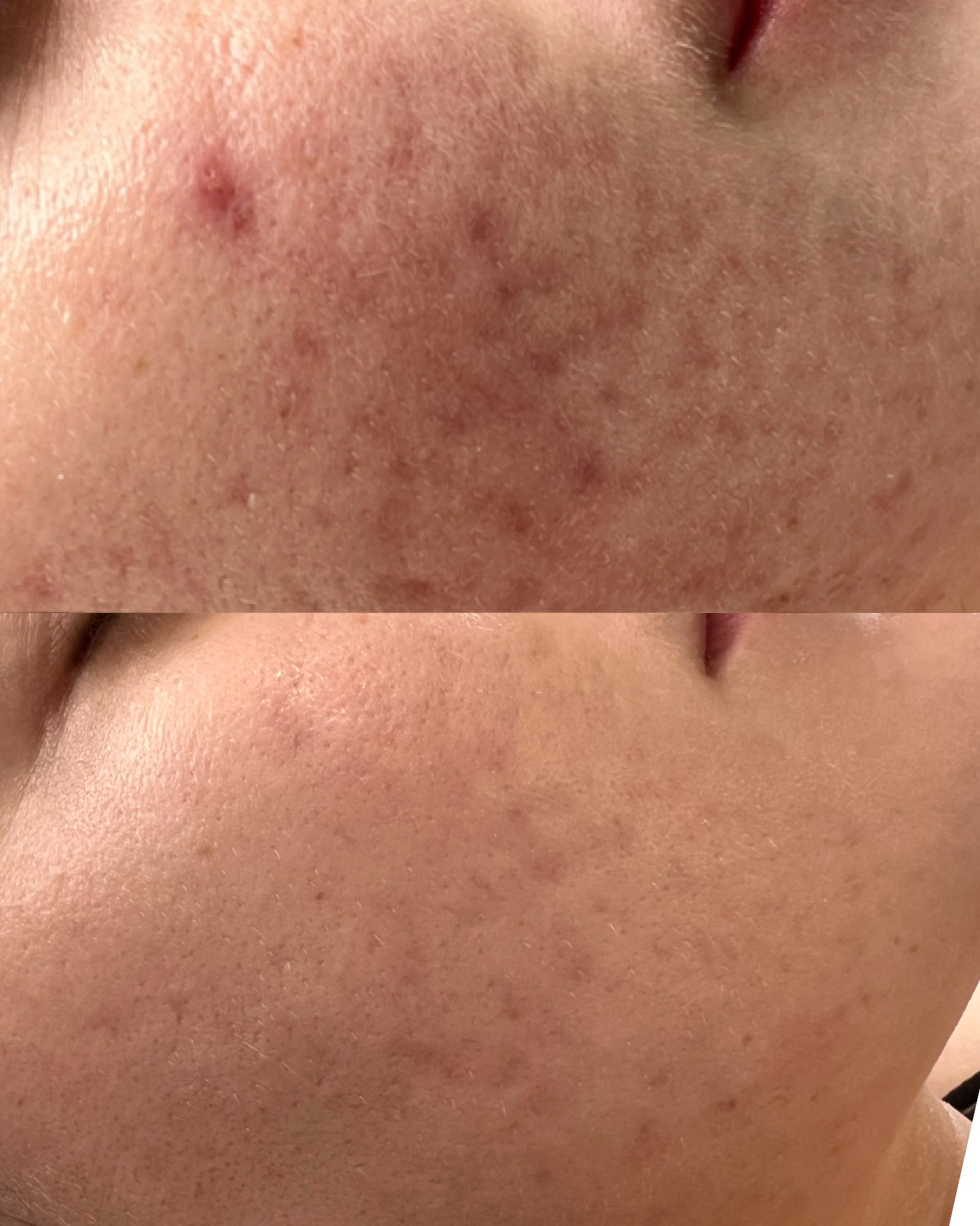 Acne + redness — before and after