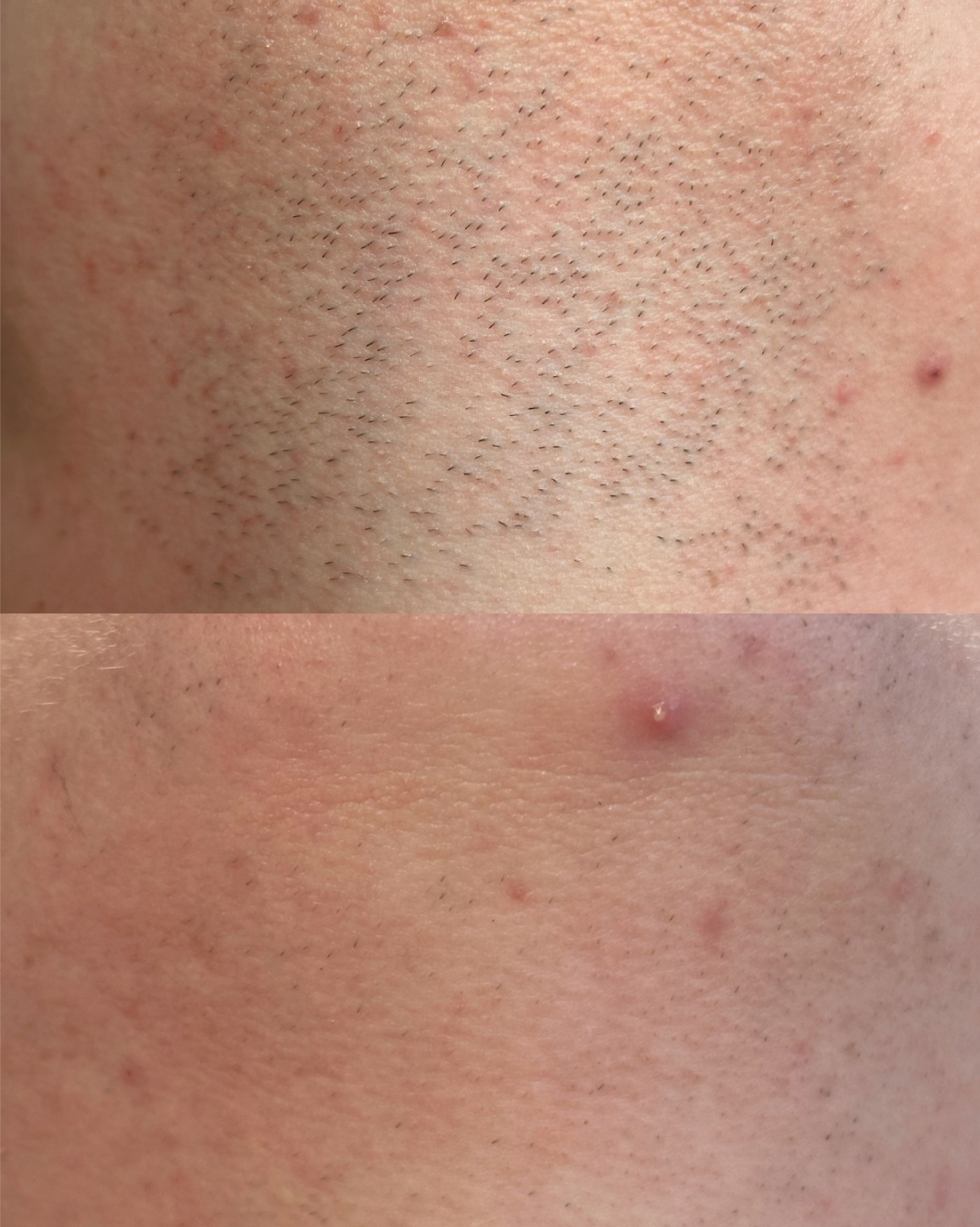 Hair reduction — before and after