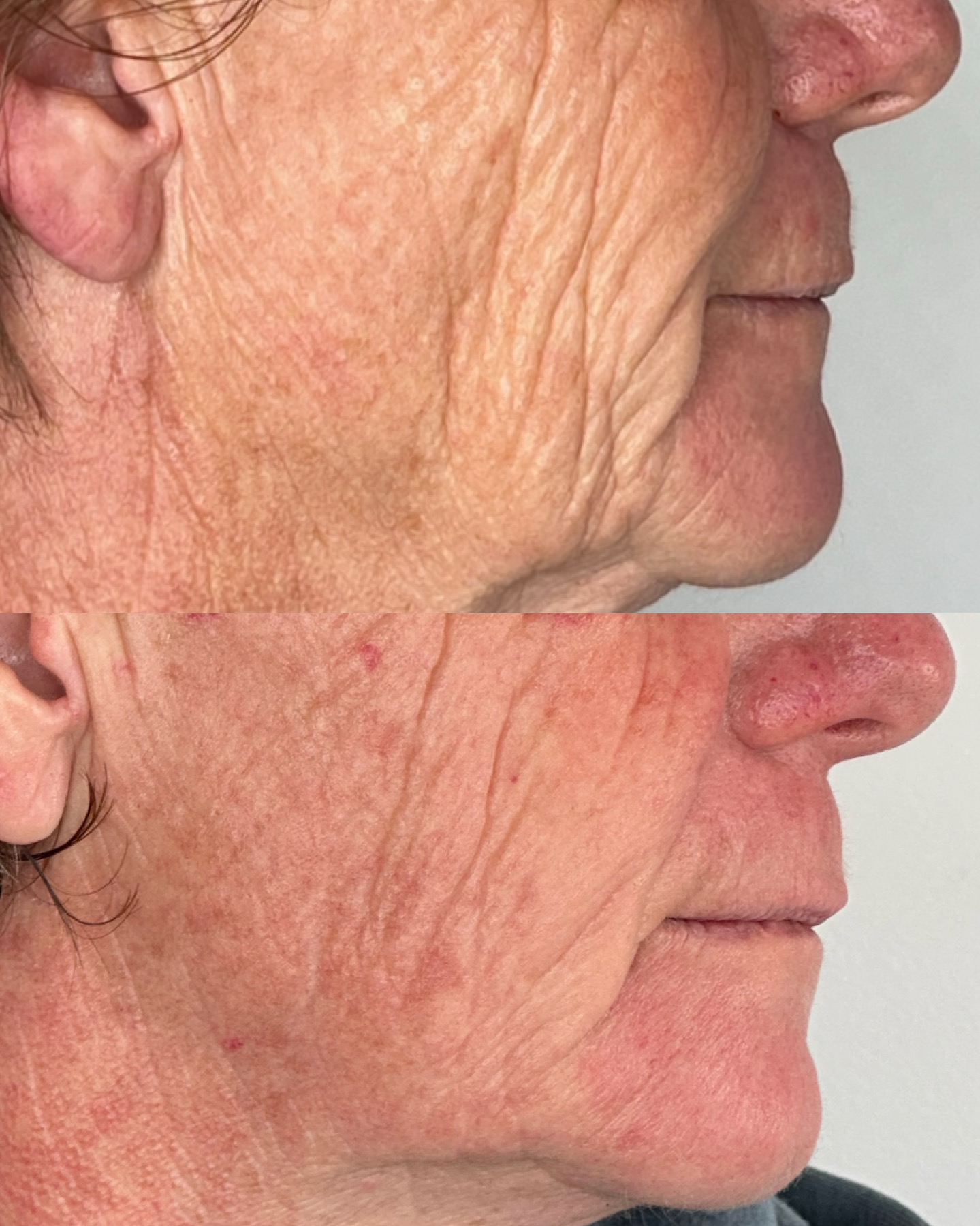 Skin texture + lines — before and after