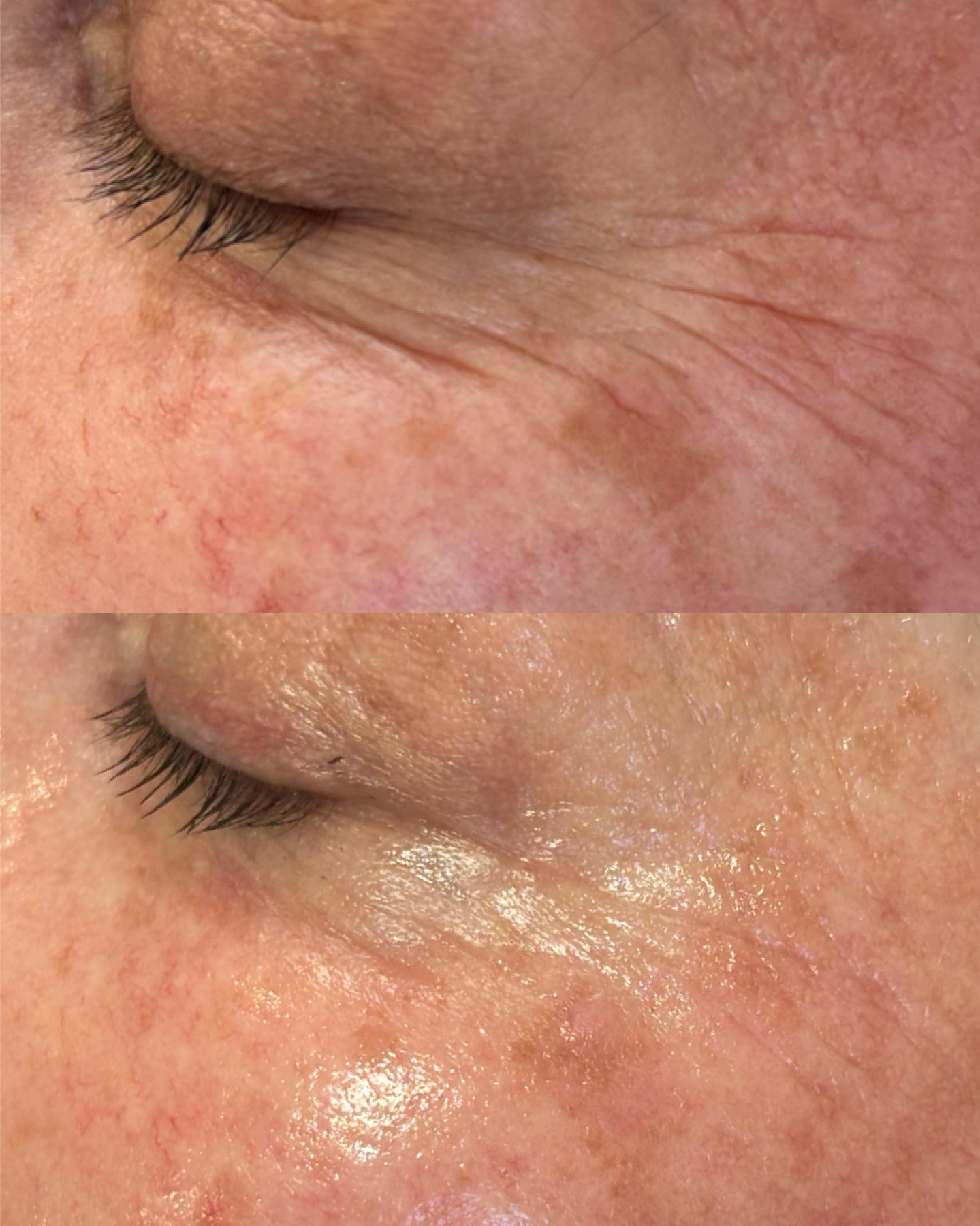 Crow's feet — before and after
