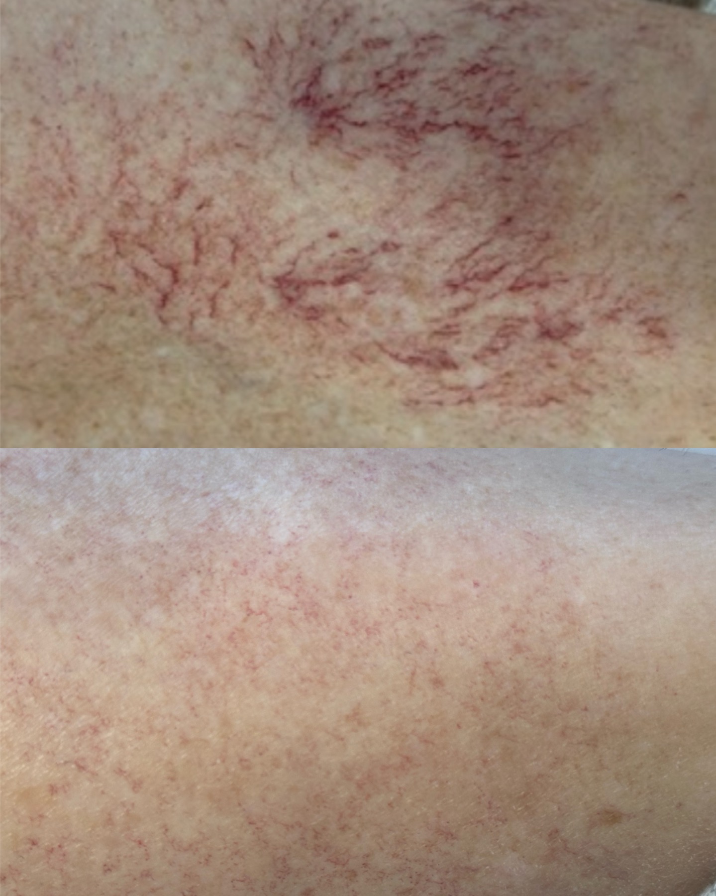 Broken capillaries — before and after