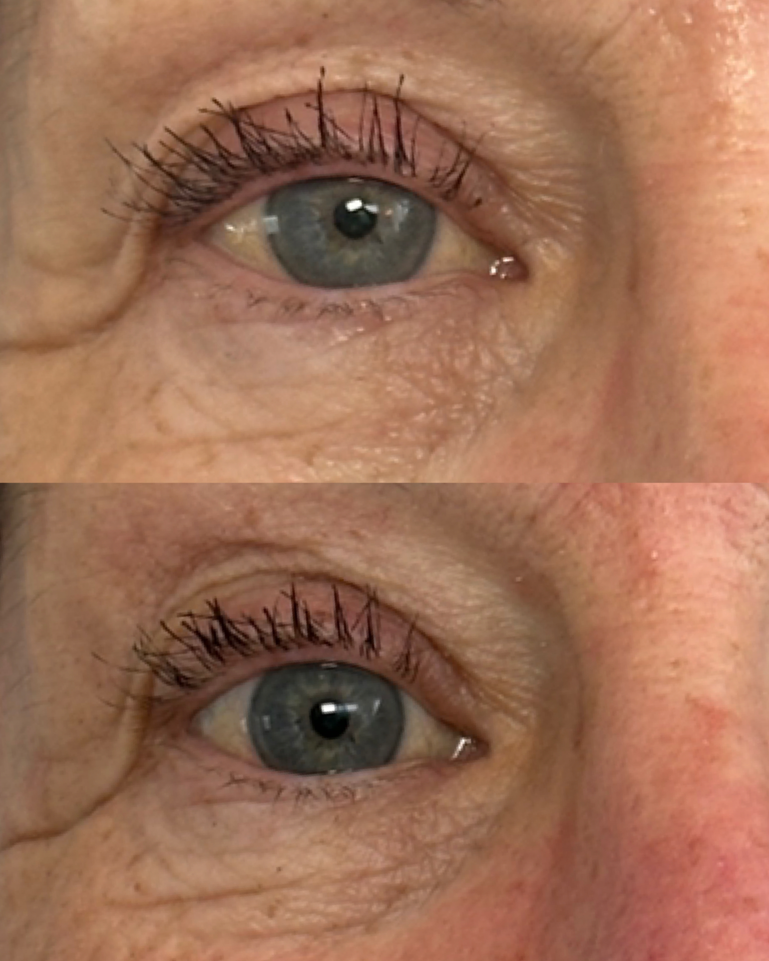 Under-eye fine lines — before and after