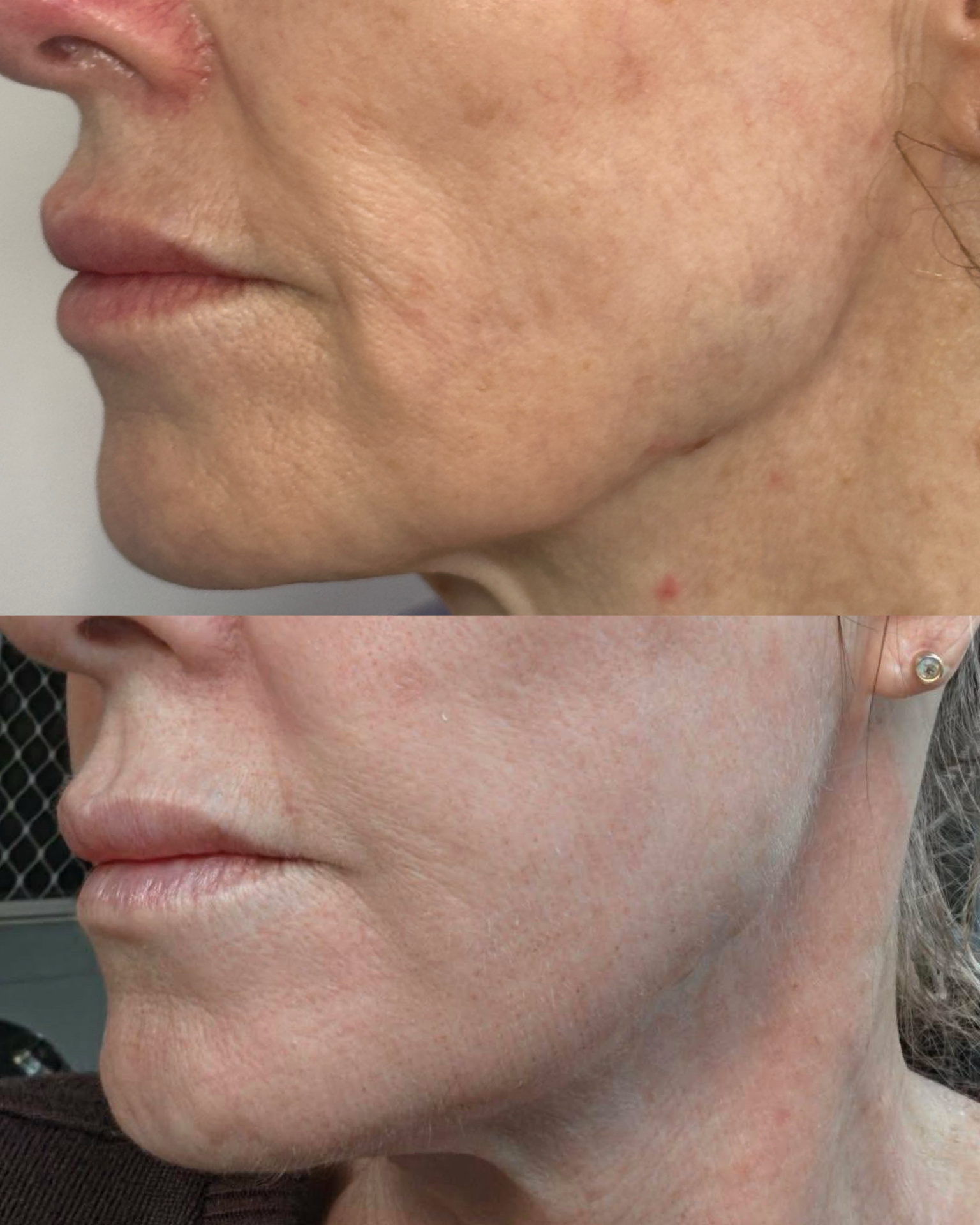 Jawline + skin tone — before and after