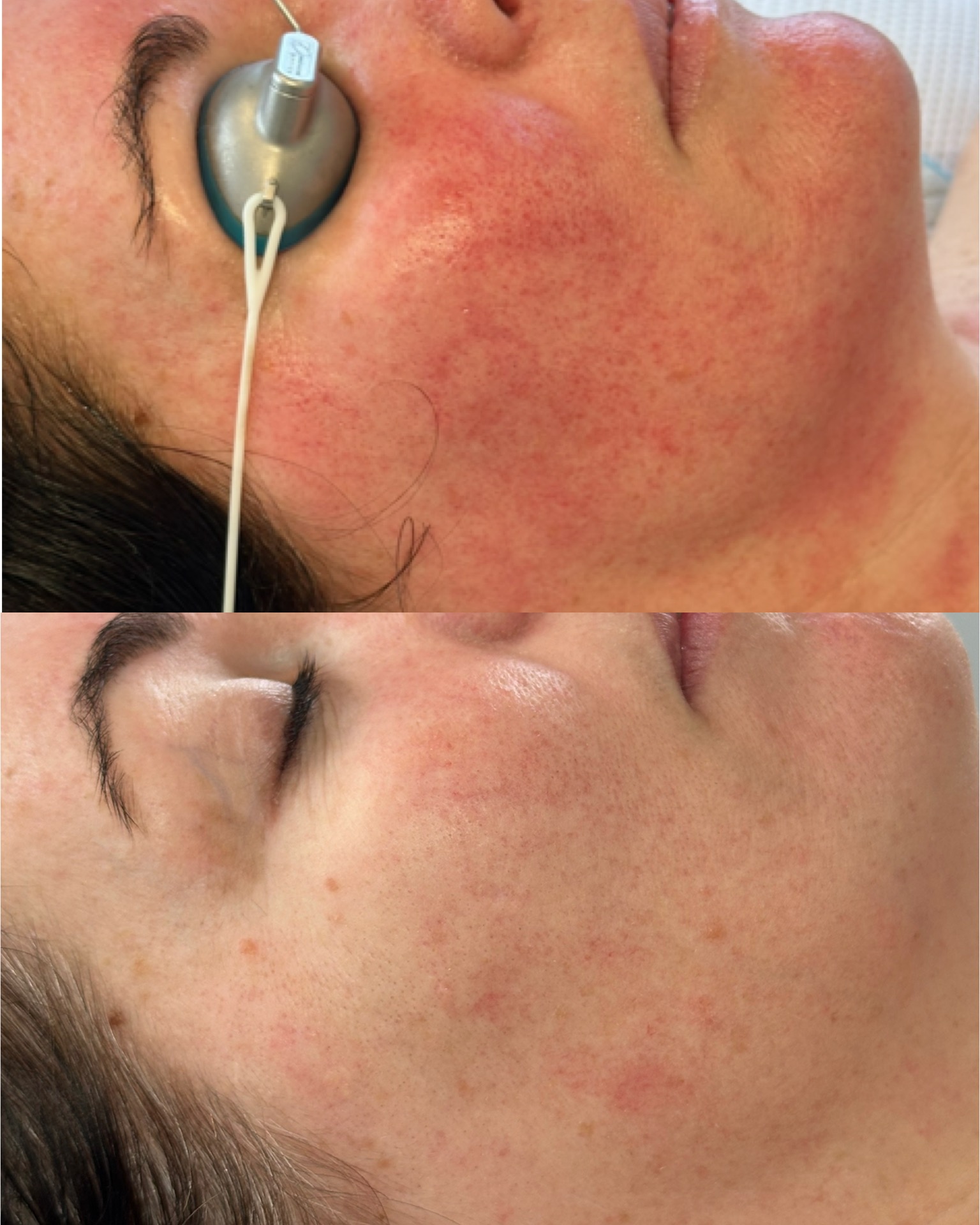 Redness + skin tone — before and after