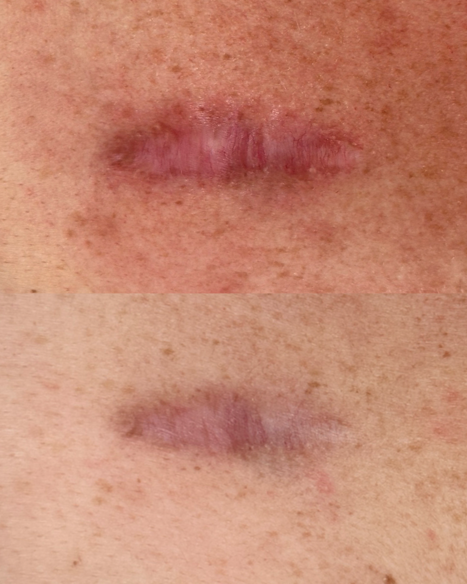 Scar softening — before and after