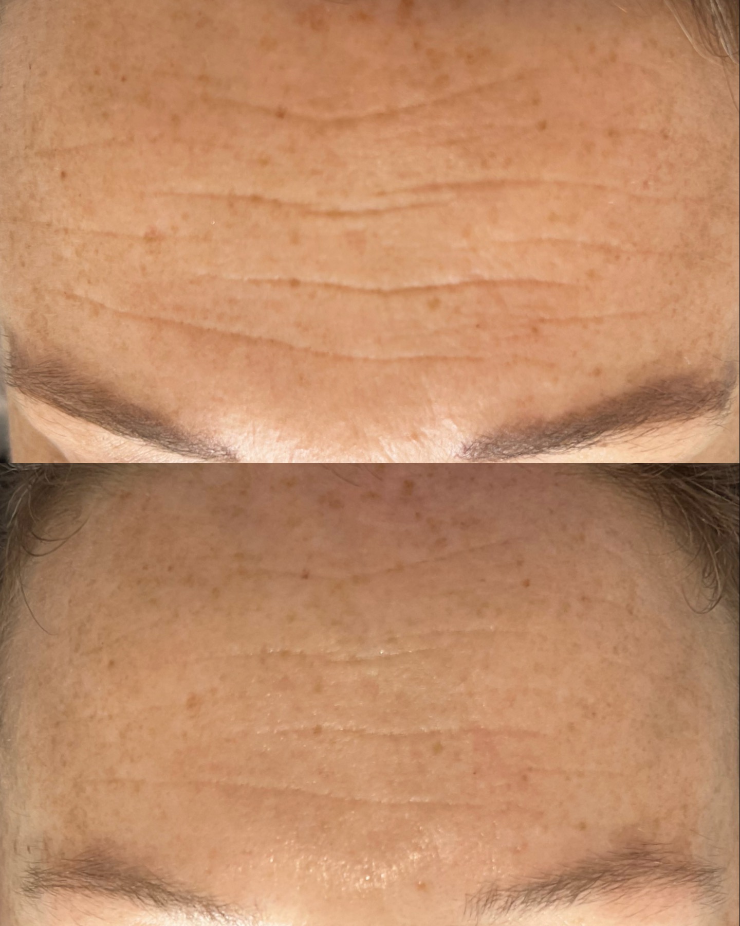 Forehead lines — before and after