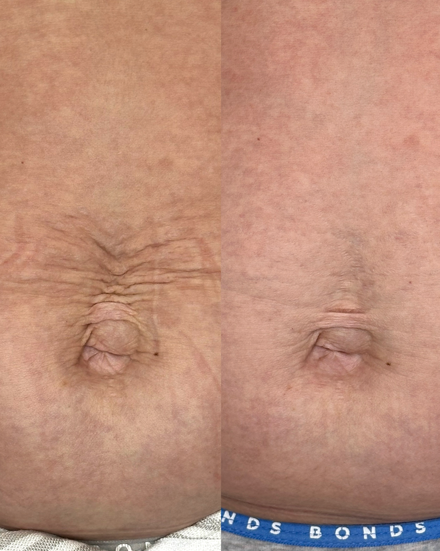 Stomach skin tightening — before and after