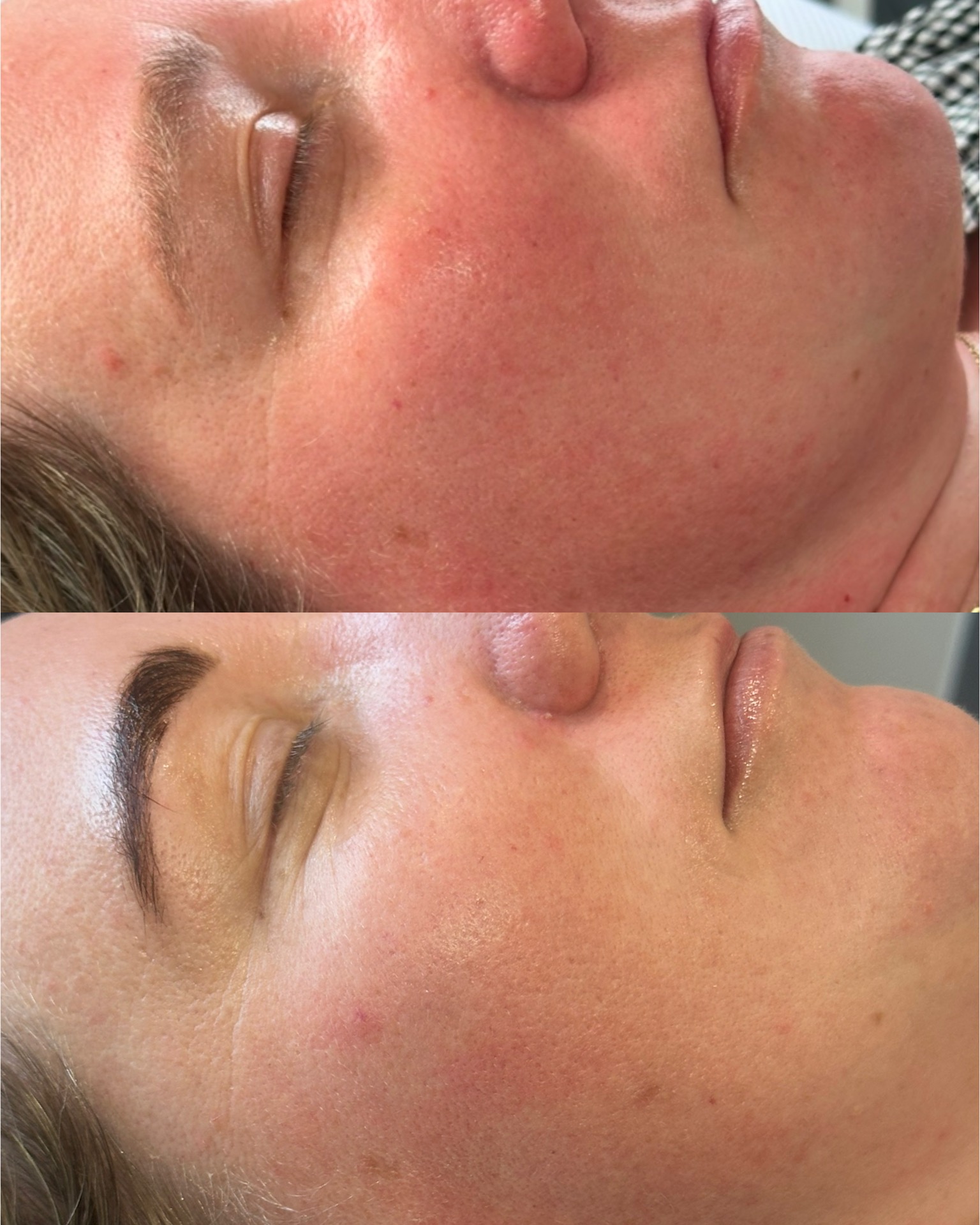Redness + skin texture — before and after