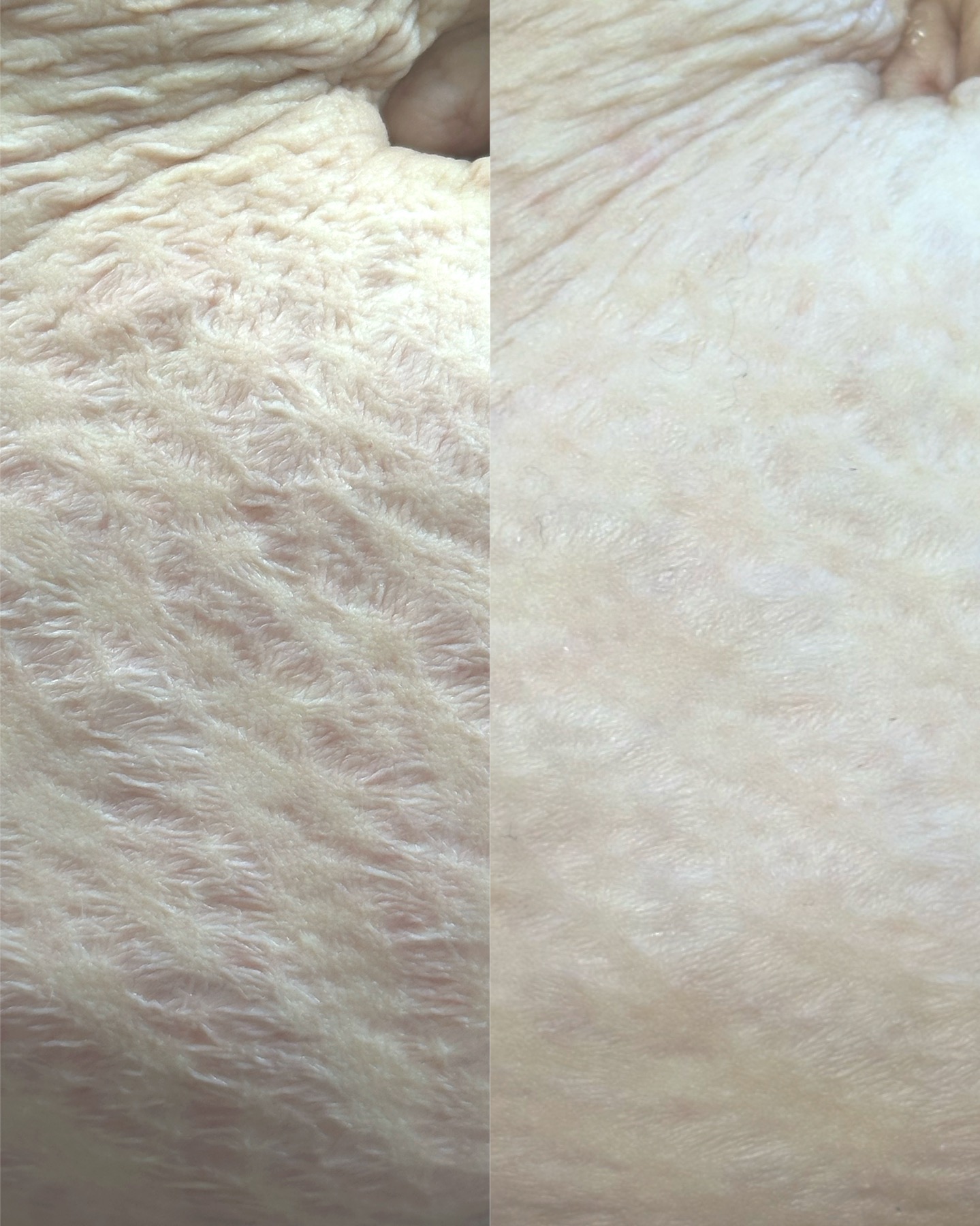 Crepey skin — before and after
