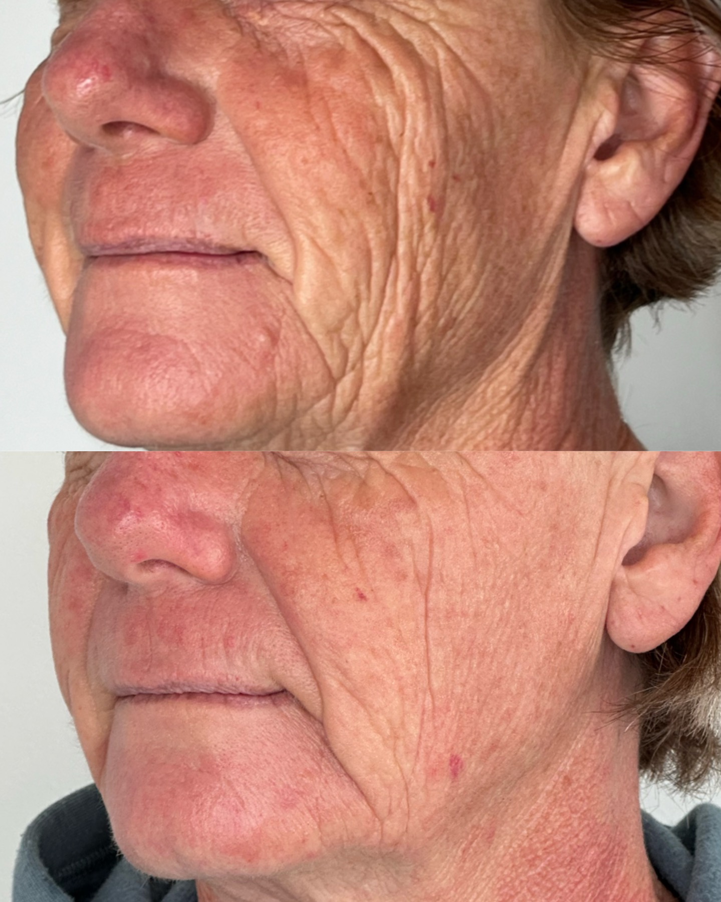 Wrinkles + sun damage — before and after