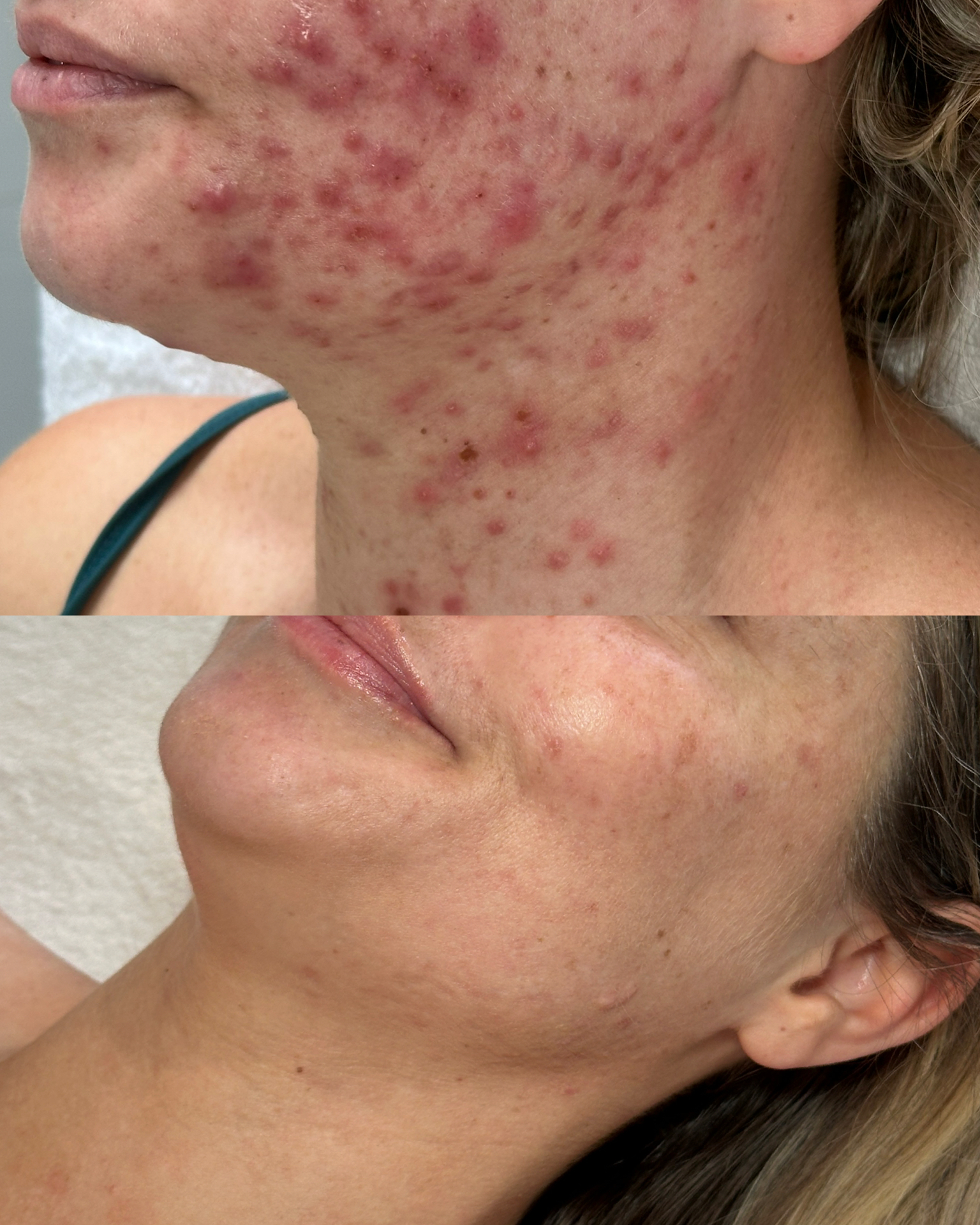 Acne — before and after