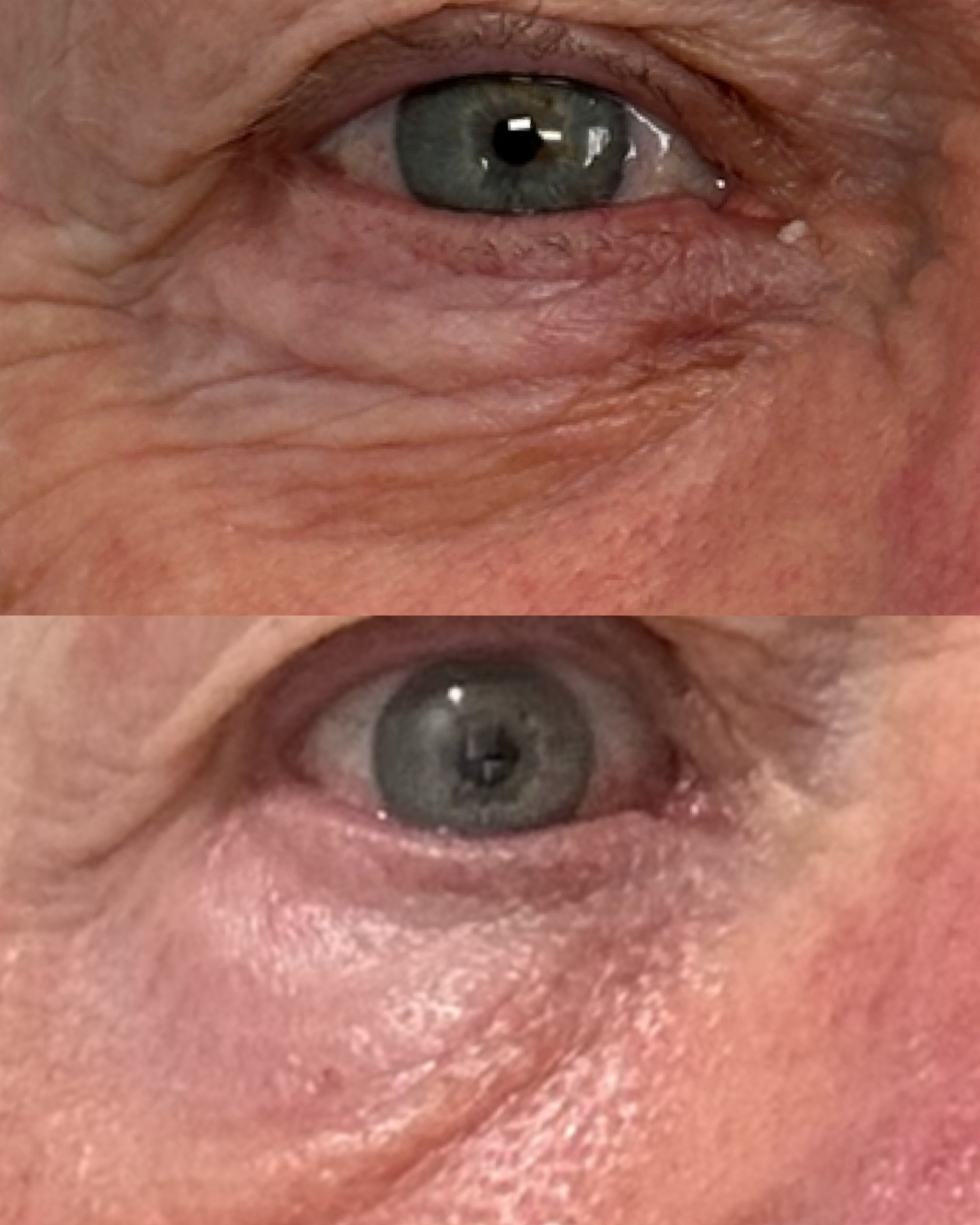 Under-eye wrinkles — before and after