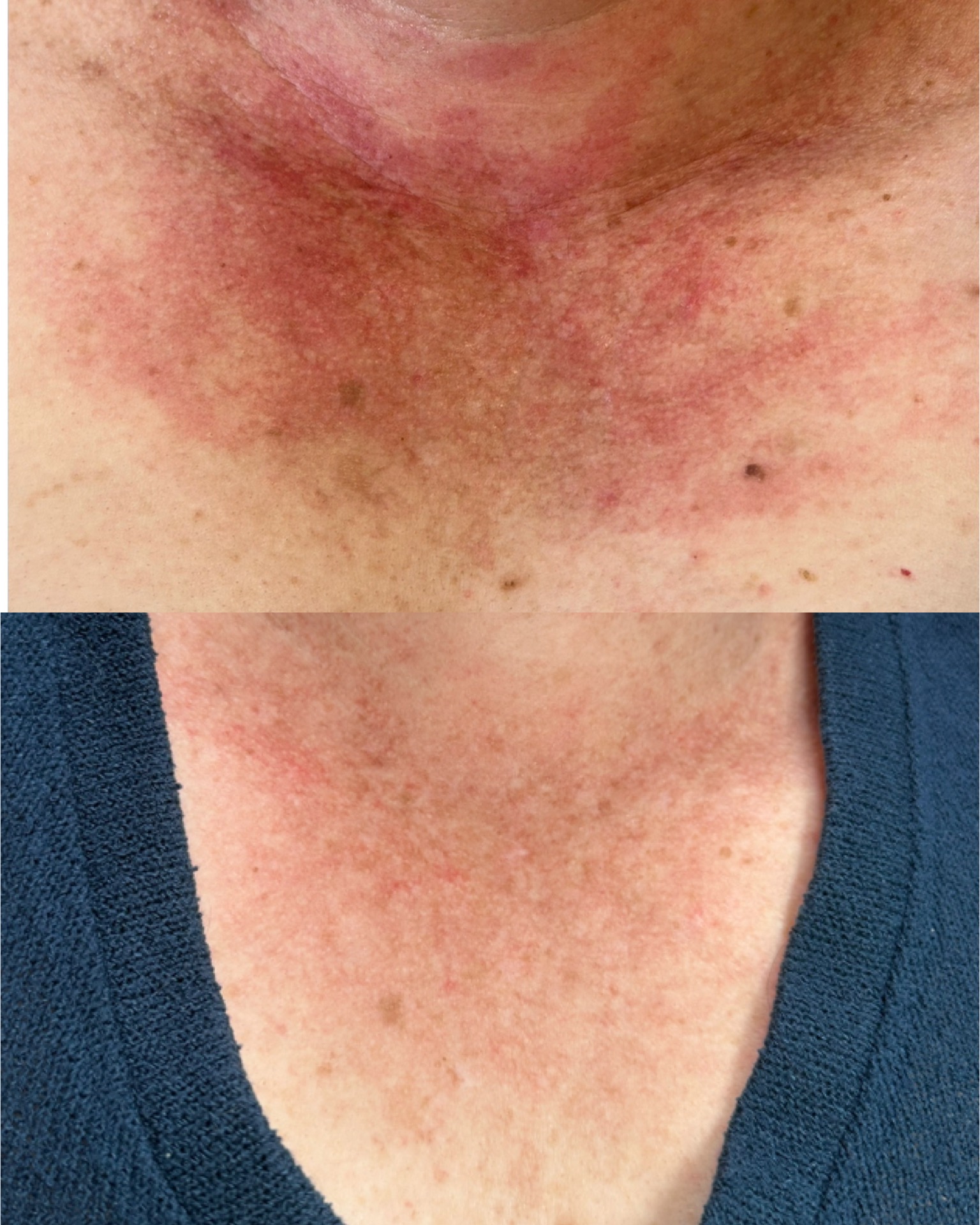 Redness + sun damage — before and after