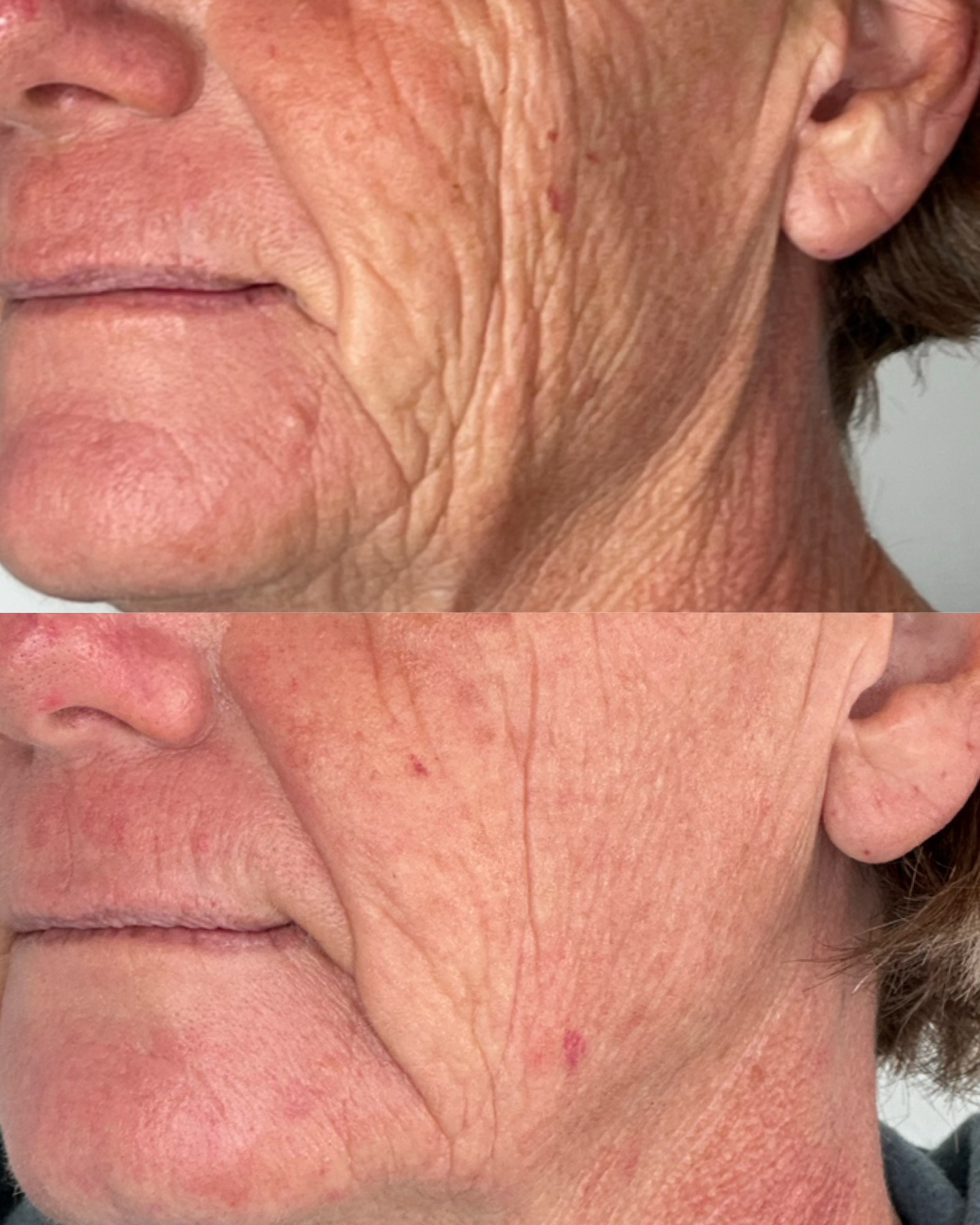 Cheek wrinkles — before and after