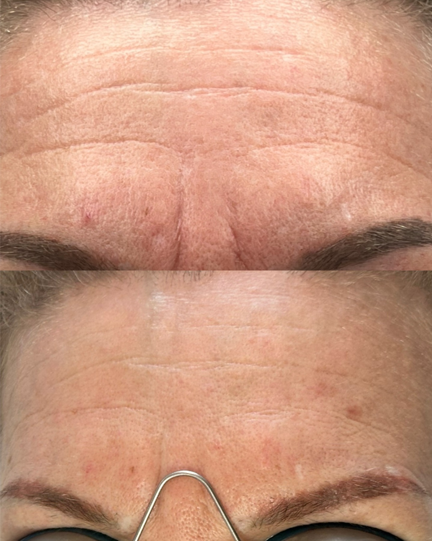 Forehead lines — before and after