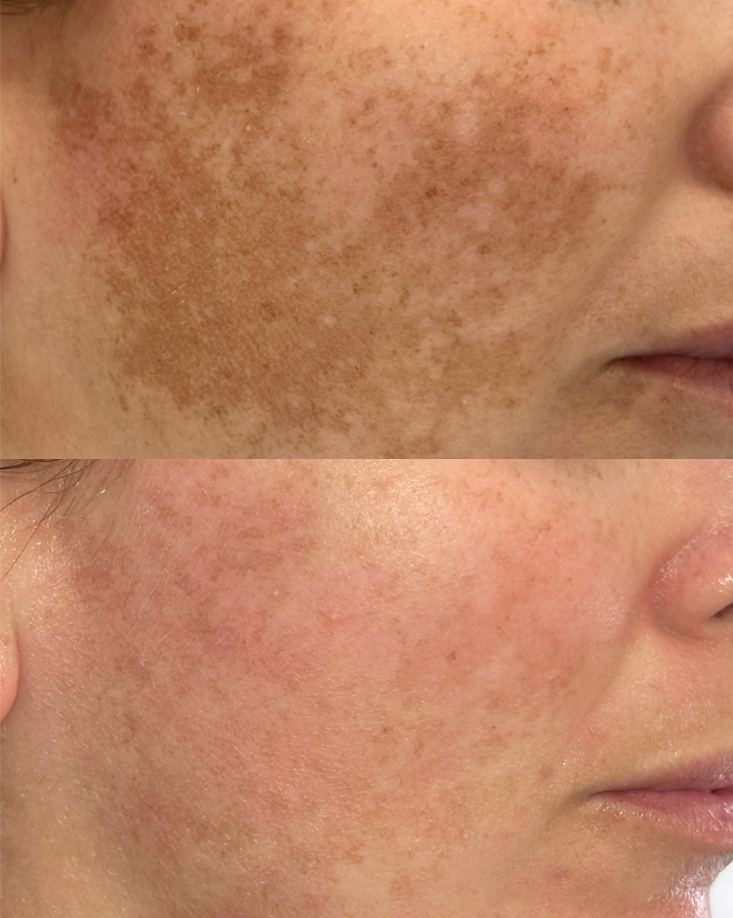 Pigmentation — before and after